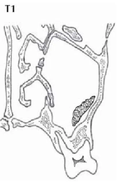 Gambar 2.4.  T1  terbatas   pada   mukosa sinus  maksilaris (Greene, 2006). 