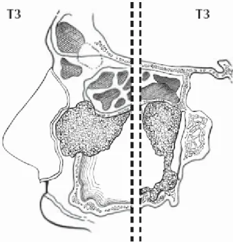 Gambar 2.6. Tumor menginvasi  dinding posterior tulang sinus 