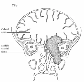 Gambar 2.8. Pandangan koronal T4b menunjukkan tumor menginvasi apeks orbita dan  atau dura, otak atau fossa kranial medial (Greene, 2006)