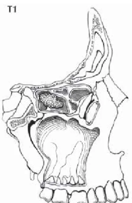 Gambar 2.9. Pada kavum nasi dan sinus  etmoidalis, T1 didefinisikan sebagai tumor  yang terbatas pada salah satu bagian, dengan  atau tanpa invasi tulang (Greene, 2006)
