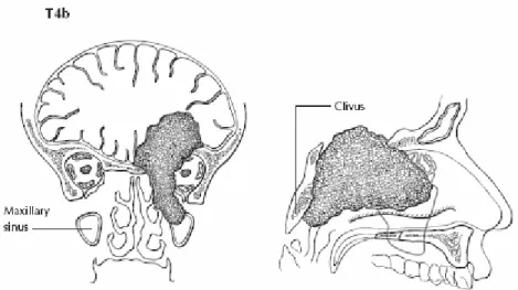 Gambar 2.13. Dua pandangan dari T4b. Pandangan koronal kiri menunjukkan invasi di  dalam apeks orbita dan otak