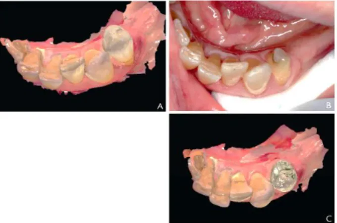 Gambar 6A Evaluasi intraoral dari restorasi definitive, B,  mahkota  zirconia  dengan  kontur  anatomi,  yang  dipasang  pada GTSL yang didukung - implan 
