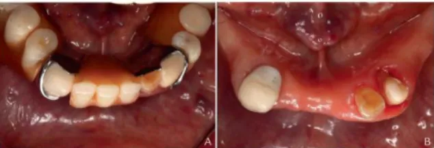Gambar 7A Mahkota penyangga yang telah ada pada gigi  kaninus kiri mandibular, B preparasi gigi penyangga yang  te-lah siap untuk di-scan digital