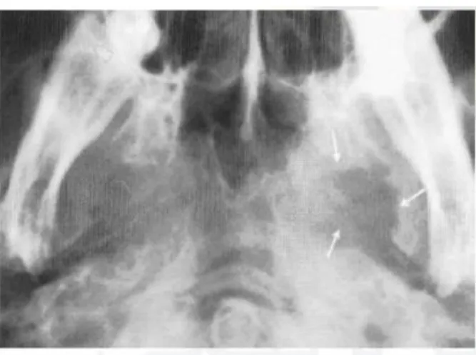Gambar 7. Erosi dari Fosa Serebri Media Sebelah Kiri (arah tanda panah)  2.  CT  (Computerized  Axial  Tomography)  Scan  dan  MRI  (Magnetic 