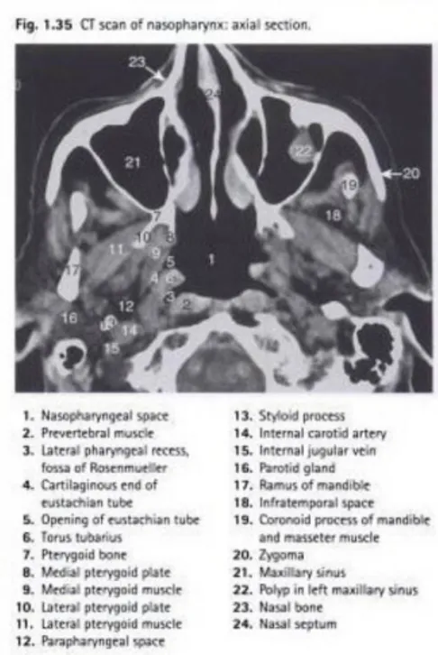 Gambar 8. CT Scan aksial nasofaring normal. 