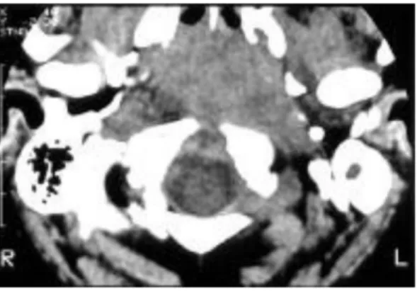 Gambar 10. CT Scan Aksial os Temporal Menunjukkan Massa di Nasofaring  (karsinoma nasofaring) 