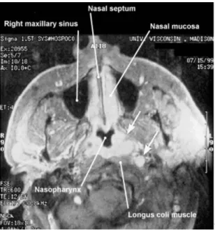 Gambar 13. MRI Potongan Sagital pada Pasien yang Baru Didiagnosis Karsinoma  Nasofaring, Menunjukkan Tumor Primer dari Karsinoma Nasofaring dan 
