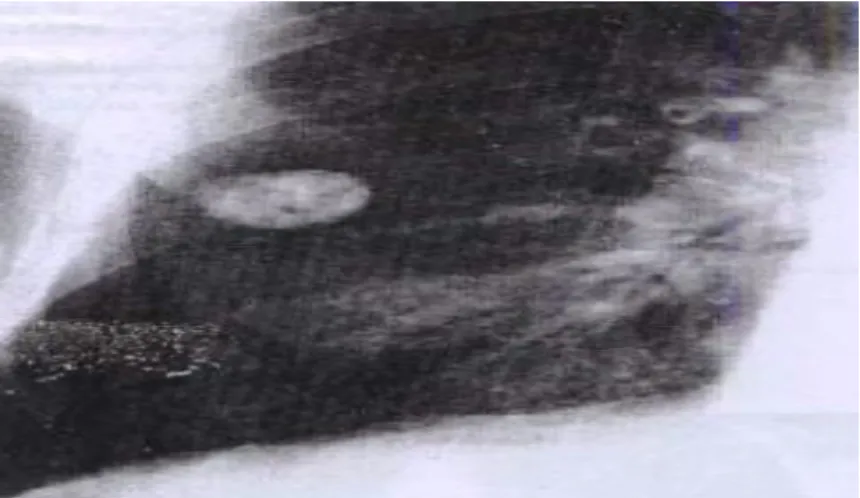 Gambar 2.6. Hamartoma 