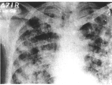 Gambar 2.4: Pemeriksaan radiografi pada dada yang menunjukkan bilateral exentensive tuberculosis
