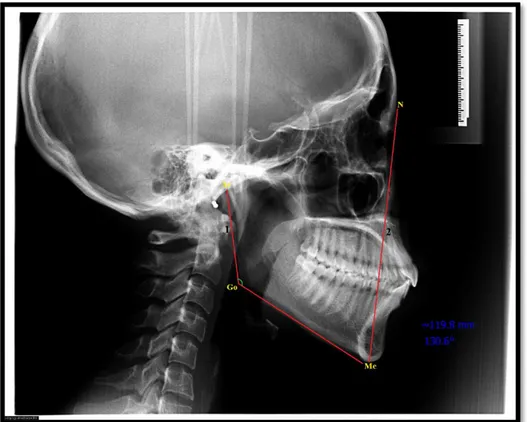 Gambar 10. Cara pengukuran (1) sudut gonial; (2) tinggi fasial anterior  (dokumentasi pribadi)                 