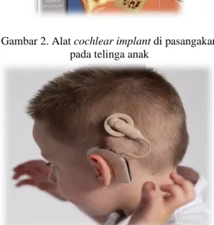 Gambar 2. Alat cochlear implant di pasangakan  pada telinga anak 