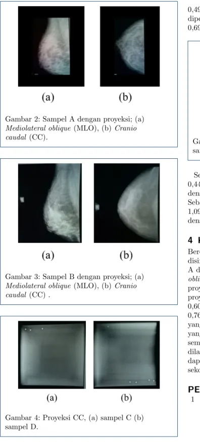 Gambar 2: Sampel A dengan proyeksi; (a) Mediolateral oblique (MLO), (b) Cranio caudal (CC).