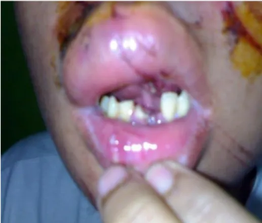 Gambar 2.3. Trauma mekanik 