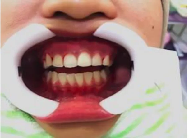 Gambar 10. Keadaan gingiva pada control periodic