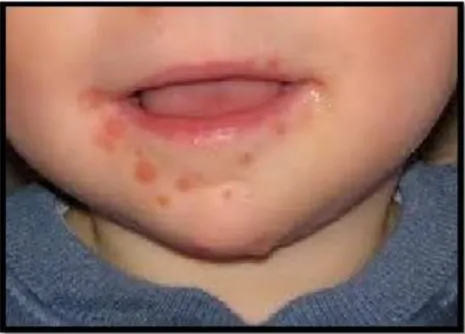 Gambar 6. Herpangina