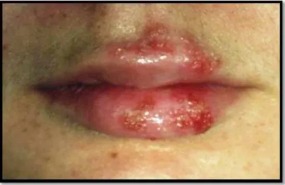 Gambar 1. Herpes Labialis
