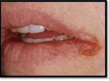 Gambar 2. Cheilitis angularis