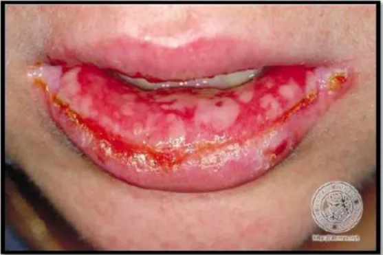Gambar 3. Erythema Multiforme