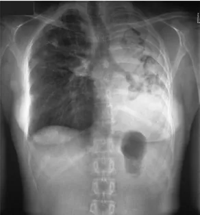 Gambar 2.4: Foto toraks posteroanterior menunjukkan aspergilloma multiple pada  pasien dengan tuberkulosis