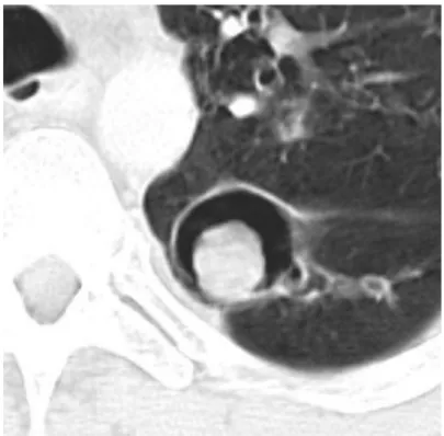 Gambar 2.6: Aspergilloma di dalam kavitas yang telah ada sebelumnya. Udara  yang berbentuk bulan sabit yang mengelilingi aspergilloma dikenal sebagai the 