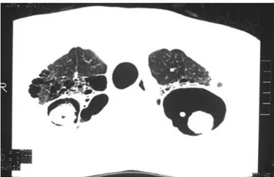 Gambar 2.7: CT toraks: Kavitas bilateral dengan fungus ball yang bergantung pada  posisi 