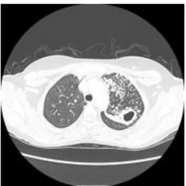 Gambar 2.9: Ct scan: tuberkulosis paru  (Sumber: http://radiopaedia.org/images/19475) 