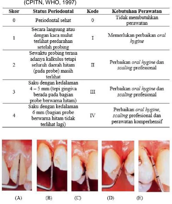 Tabel  1.  The  Community  Periodontal  Index  of  Treatment  Needs (CPITN, WHO, 1997)