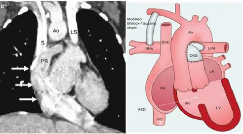 Diagram memperlihatkan hubungan PA dan Ao Asc. PA diligasi dibawah anastomosis. RPA dan LPA bisa melekat pada sirkulasi extracardiac Fontan (terutama pd dewasa, tdk tergambar disini).