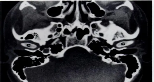 Gambar  10.    Standar  normal  Temporomandibular  joint  pada  CT                                          Scan  transaxial