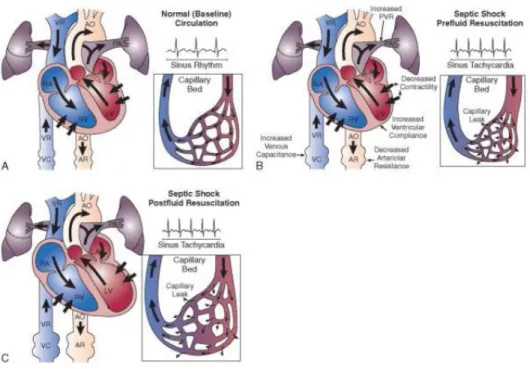 Gambar 2. Cardiovascular changes associated with septic shock and the effects of  fluid resuscitation.