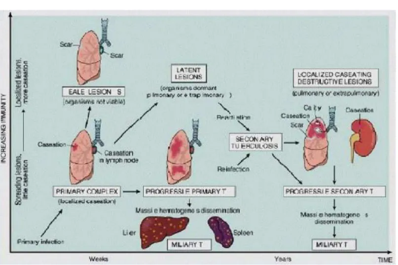 Gambar 3. Patogenesis TB Paru