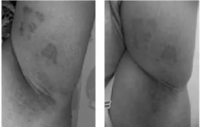 Gambar 1. Lesi kulit ketiak dan lengan atas kiri sebelum terapi (a),  dan 3 minggu setelah terapi (b) 