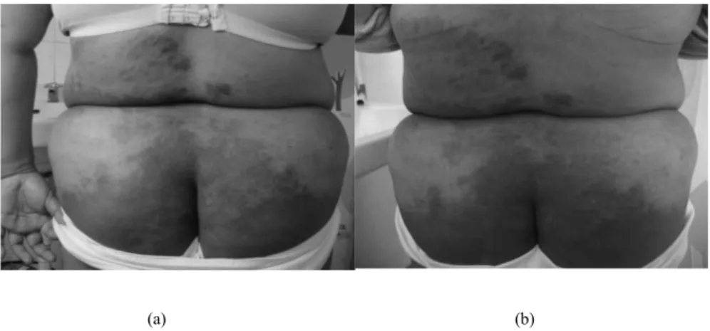 Gambar 4. Lesi kulit bokong dan punggung sebelum terapi (a) dan 3 minggu setelah terapi (b) 