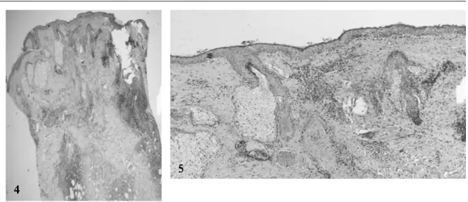 Gambar 6.  Subkutan tampak infiltrasi limfosit pada  lobulus jaringan lemak dan nekrosis  jaringan lemak.