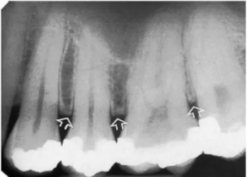 Gambar radiografi teknik periapikal pada periodontal yang sehat
