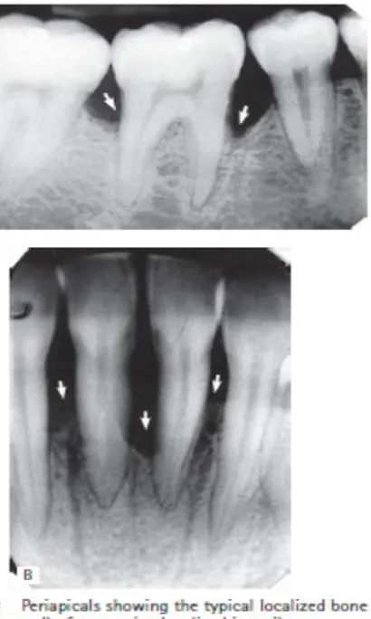 Gambar radiografi periapikal periodontitis juvenile