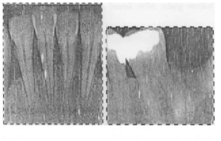 Gambar radiografs kehilangan tulang horizontal bagian proximal  ( www. studentdentist.ca )