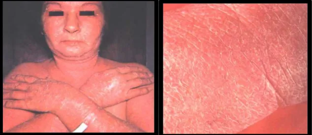 Gambar 6. Dermatitis eksfoliativa, erupsi dan skuama di wajah, lengan dan tubuh. 