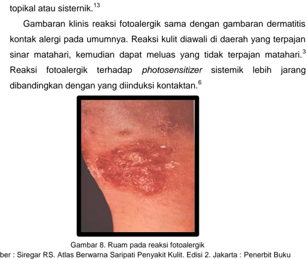 Gambar 8. Ruam pada reaksi fotoalergik 