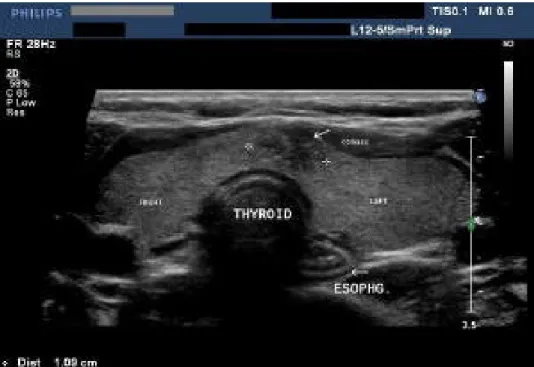 Gambar menunjukkan nodul tiroid yang malignan