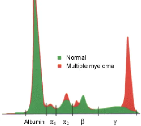 Gambar  1.  Elektroforesis  protein  serum  pada  mieloma  multiple  menunjukkan  parapotein  yang  abnormal  pada  region  globulin  γ  dengan  penurunan kadar dasar globulin β dan γ