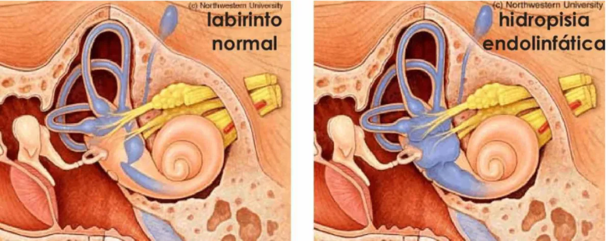 Gambar 2. Labirin Normal dan Hidrops Endolimfa. 5