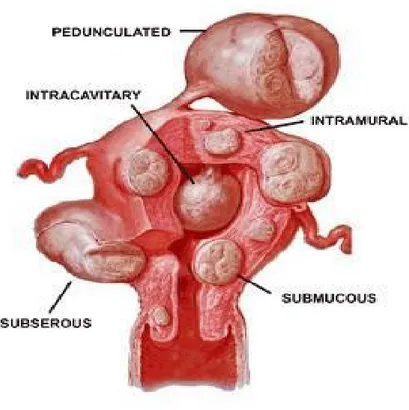 Gambar 1. Gambar Jenis-jenis mioma uterus