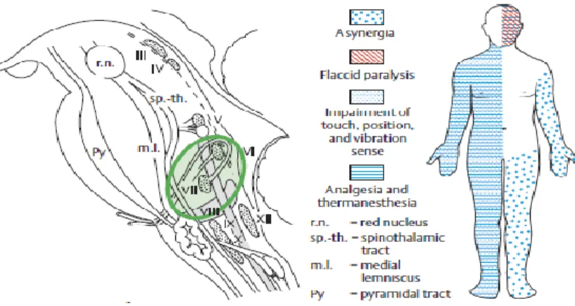 Gambar 6. Sindrom tegmentum pontis kaudale  Tabel 7. Kerusakan struktur batang dan efek yang terjadi: 