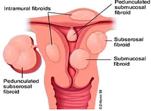 Gambar 1. Jenis-jenis mioma uteri  23 