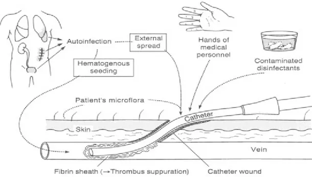 Gambar 1. Sumber infeksi pada pemasangan kateter intravascular (Weinstein et.al, 1997)