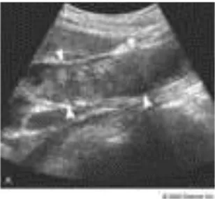 Gambar menunjukan Ascending Obstructive  Cholangitis , tampak dilatasi dari ductus utama 