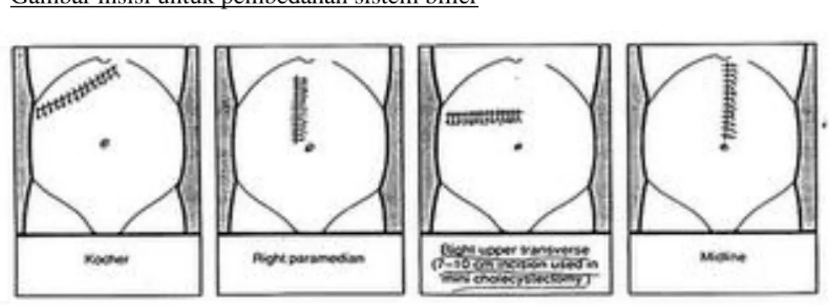 Gambar insisi untuk pembedahan sistem bilier 