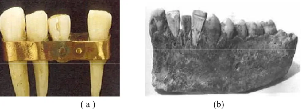 Gambar I.1 Penggunaan emas (a) dan kayu (b) sebagai salah satu biomaterial yang digunakan di bidang kedokteran gigi di masa lalu [3] .