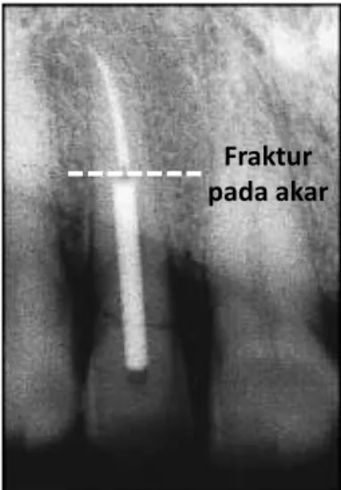 Gambar 1.1 Kegagalan (failure) pada pasak endodontik (Wadhwani, 2000)    